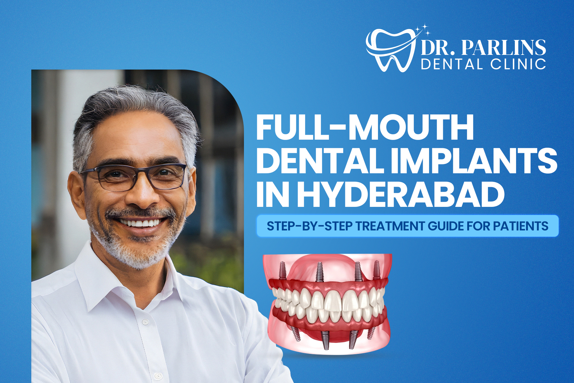 Full-Mouth Dental Implants in Hyderabad—Step-by-Step Treatment Guide for Patients