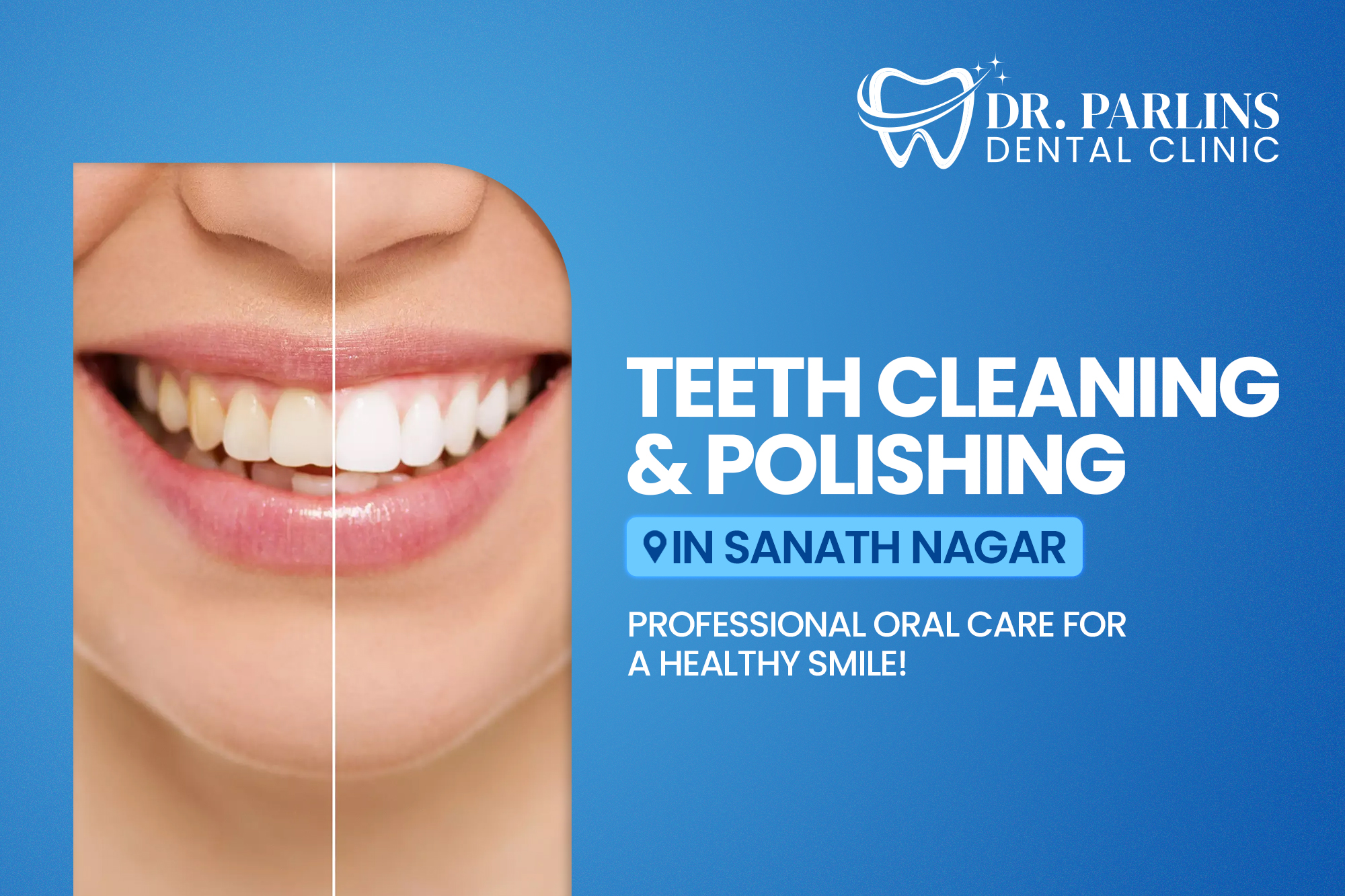 Teeth Cleaning & Polishing in Sanath Nagar – Professional Oral Care for a Healthy Smile