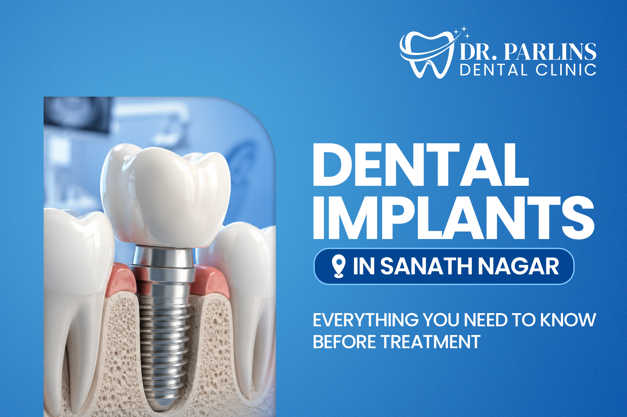 Dental Implants in Sanath Nagar—Everything You Need to Know Before Treatment